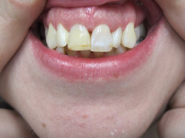 Internal Bleaching After